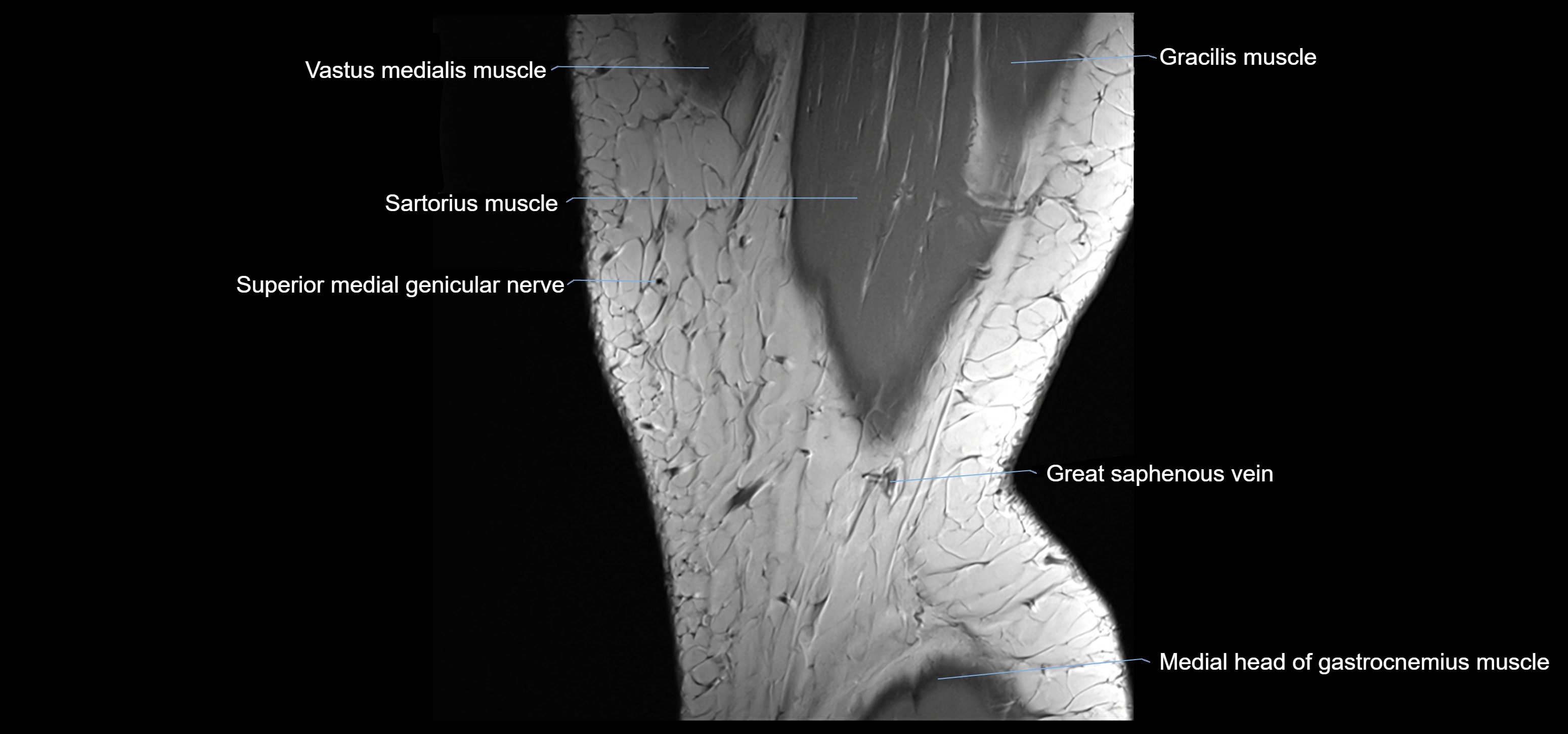 MRI knee sagittal cross sectional anatomy labelled 3T radiology image-00002.webp